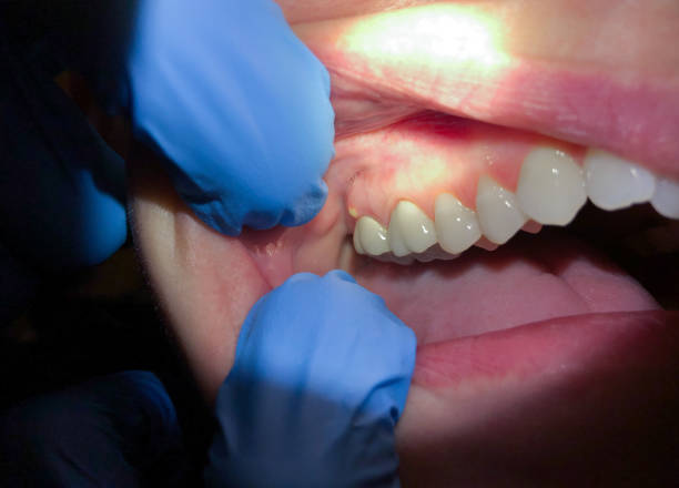 Best Tooth Infection Emergency Dentist  in Wimberley, TX